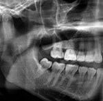 Orthopantomogramm als bildgebender Befund in der Altersdiagnostik